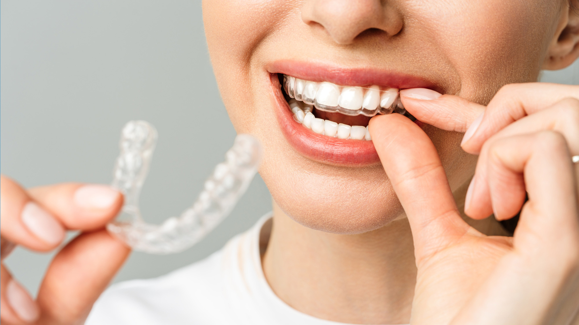 Διάφανα Μασελάκια